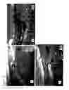 Fig. 09 - Hydrocephalus treatment