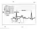 Fig. 01 - Apparatus and method for analysis of high frequency QRS complexes