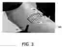 Fig. 04 - Cannula Inserting System