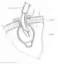 Fig. 01 - Ophthalmic Cannula