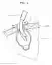 Fig. 05 - Ophthalmic Cannula