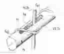 Fig. 01 - Resilient External Fixator Between Two Bone Portions
