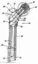 Fig. 01 - Intramedullary nail system and method for fixation of a fractured bone