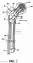 Fig. 02 - Intramedullary nail system and method for fixation of a fractured bone