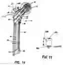 Fig. 09 - Intramedullary nail system and method for fixation of a fractured bone