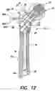 Fig. 11 - Intramedullary nail system and method for fixation of a fractured bone