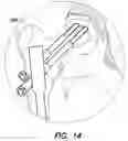 Fig. 13 - Intramedullary nail system and method for fixation of a fractured bone