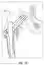 Fig. 14 - Intramedullary nail system and method for fixation of a fractured bone