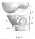 Fig. 08 - Device, system and method for positioning or preparing the positioning of a medical operating instrument