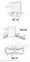 Fig. 04 - Methods and devices for bone, joint, and ligament reconstruction with bands