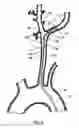 Fig. 08 - Delivery system for an embolic protection device