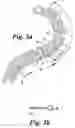 Fig. 04 - Apparatus for the correction of skeletal deformities