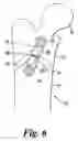 Fig. 07 - Apparatus for the correction of skeletal deformities