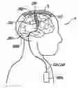 Fig. 01 - System and method for treating Parkinson's Disease and other movement disorders