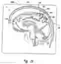 Fig. 03 - System and method for treating Parkinson's Disease and other movement disorders