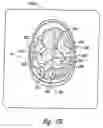Fig. 04 - System and method for treating Parkinson's Disease and other movement disorders