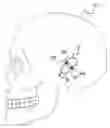 Fig. 01 - Fixation methods and systems for cochlear implant component or other implantable devices