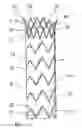 Fig. 01 - Flexible stent-graft