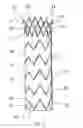Fig. 04 - Flexible stent-graft
