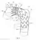 Fig. 05 - Flexible stent-graft