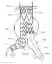 Fig. 07 - Flexible stent-graft