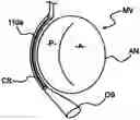 Fig. 01 - Devices and methods for heart valve treatment