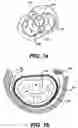 Fig. 02 - Devices and methods for heart valve treatment