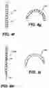 Fig. 07 - Devices and methods for heart valve treatment