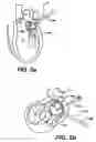 Fig. 08 - Devices and methods for heart valve treatment