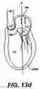 Fig. 22 - Devices and methods for heart valve treatment