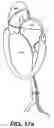 Fig. 35 - Devices and methods for heart valve treatment
