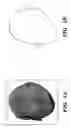 Fig. 02 - Orthotic device for preventing and/or correcting deformational posterior plagiocephaly