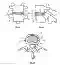 Fig. 07 - Intervertebral Disc Restoration
