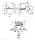 Fig. 08 - Intervertebral Disc Restoration