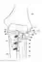 Fig. 01 - Lateral elbow prosthesis—proximal radioulnar joint