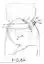Fig. 09 - IMPLANT AND A METHOD FOR PARTIAL REPLACEMENT OF JOINT SURFACES