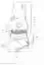 Fig. 01 - Ankle prosthesis for the arthrodesis of the calcaneum