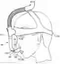 Fig. 01 - Nasal interface