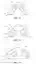 Fig. 14 - Nasal interface