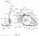 Fig. 11 - Tracked bicycle