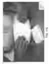 Fig. 71 - PACKAGE HAVING VACUUM PACKED ABSORBENT ARTICLE AND METHODS THEREOF