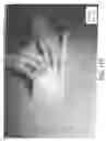Fig. 74 - PACKAGE HAVING VACUUM PACKED ABSORBENT ARTICLE AND METHODS THEREOF