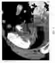 Fig. 03 - Composition and Method for Direct Visualization of the Human Appendix