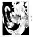 Fig. 05 - Composition and Method for Direct Visualization of the Human Appendix