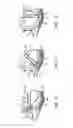 Fig. 09 - Urethral support system