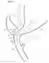 Fig. 07 - Application of procedure through natural orifice