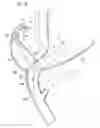 Fig. 09 - Application of procedure through natural orifice