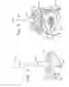 Fig. 05 - Annuloplasty ring with offset free ends