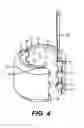 Fig. 03 - Split body swelling packer