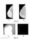 Fig. 05 - Method and Arrangement Relating to X-Ray Imaging
